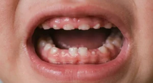 Close-up of a baby's open mouth revealing swollen gums and erupting lower central incisors as key signs baby is teething.