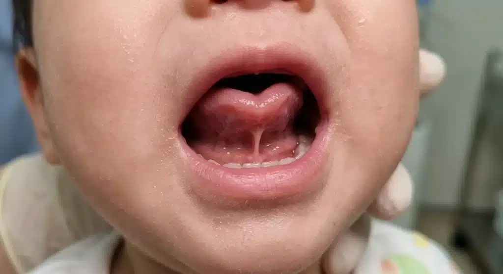Close-up of open mouth showing tight lingual frenulum in a tongue tied baby