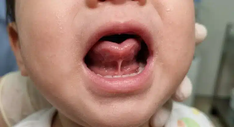 Close-up of open mouth showing tight lingual frenulum in a tongue tied baby